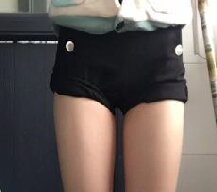 大腿吸脂手术后大腿更加苗条了