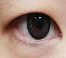 双眼皮开眼角一起做眼睛更有神了