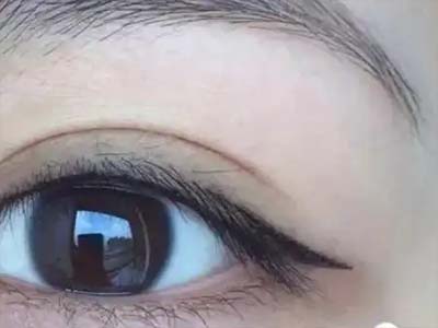 不同类型的初眼，如何选择双眼皮方式