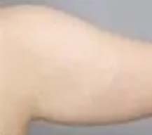 手臂吸脂的变化效果很明显，穿衣服也是很赞