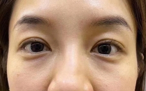 利用医美技术终于摆脱眼袋