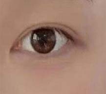割双眼皮