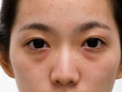 内切去眼袋 恢复精致美眼