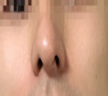 做完隆鼻手术效果确实让人倍感意外