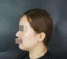 做面部吸脂手术后我的脸蛋明显变漂亮了