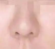 激光治疗酒糟鼻