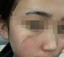 疤痕治疗手术后脸蛋变得更加漂亮了
