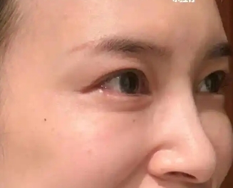 术后果然年轻了很多