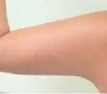 手臂做了吸脂后真的细了好多