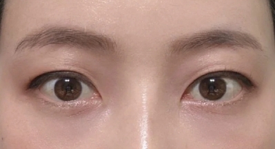 术后眼睛看起来很有活力