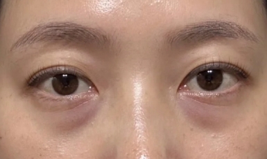 选择内切法摆脱眼袋