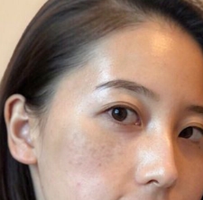 改善肌肤 光子嫩肤让肌肤恢复光泽