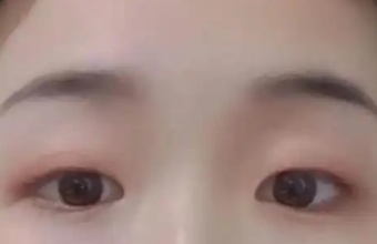 打造精致美眼 双眼皮让气质提升