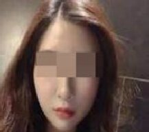 面部自体脂肪填充手术让我越来越年轻
