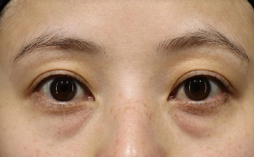 切除眼袋 重获活力美眼