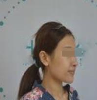 面部自体脂肪填充手术当天