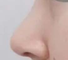 隆鼻变好看
