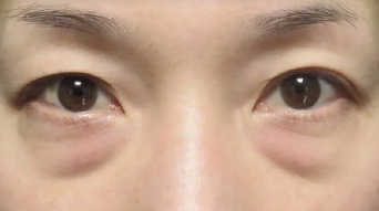 去除眼袋 整个人的形象得到了提升