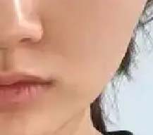 注射50单位除皱脸型瘦很多