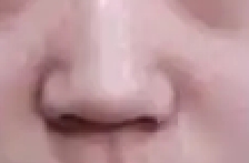 蒜头鼻