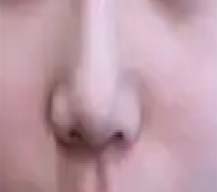 鼻综合整形鼻子变精致又好看