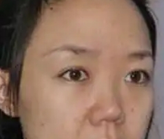 隆鼻术后整个人变化很大