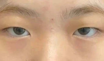 双眼皮让我整个人都变得更精致
