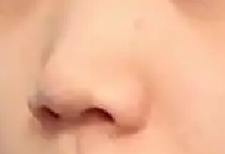 鼻子塌