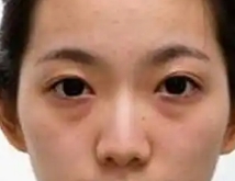 去除眼袋 让双眼重焕活力感