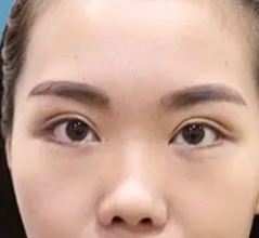 选择肋软骨隆鼻 塑造立体美鼻