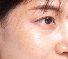 光子嫩肤让肌肤恢复细腻白嫩