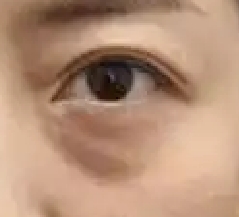 眼袋