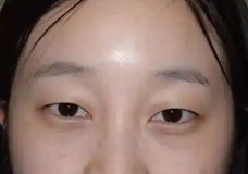 全切双眼皮轻松打造靓丽美眼