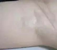 手术改善狐臭人都变自信了