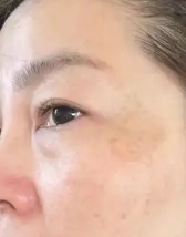 光子嫩肤让我的肌肤重焕光彩