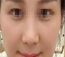 自体脂肪填充面部更显年轻