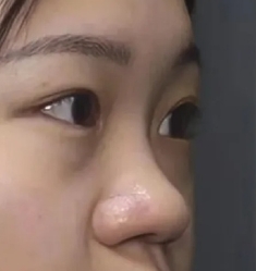 软骨隆鼻 让鼻型真的变得立体