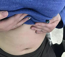 腰腹吸脂让我瘦腰不是梦