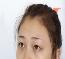 做完双眼皮会显得有精神不少