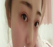 双眼皮恢复的很不错