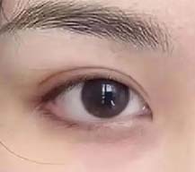 做了双眼皮后我同学都说我变好看了