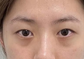 做完双眼皮整个人看起来变化很大