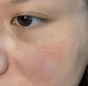改善肌肤暗沉 光子嫩肤效果惊喜