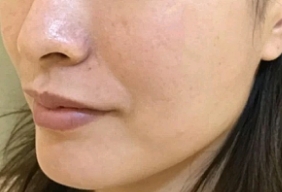 解决肌肤松弛选择热玛吉除皱