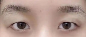  做完双眼皮手术  眼型变得精致了