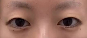 解决单眼皮难题 打造精致美眼