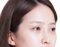 告别塌鼻梁 假体隆鼻让你重获自信人生