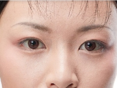 黑眼圈星人自救指南！激光祛黑如何改写眼周暗沉命运