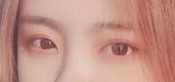 术后30天，眼看双眼皮也变得越来越自然了。