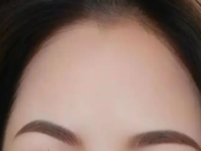想知道自己适合做自体脂肪填充额头吗？这就来告诉你